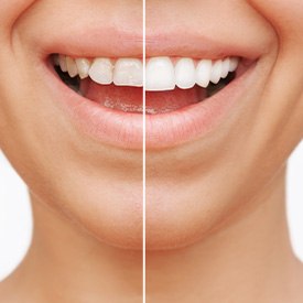 Before and after of cosmetic dentistry