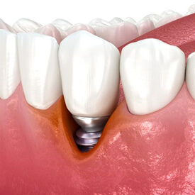 illustration showing gum recession around a dental implant