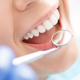 Nose-to-chin view of a woman smiling with a dental mirror at her teeth