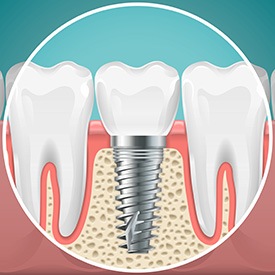 Illustration of a dental implant circled between neighboring teeth